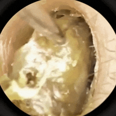 Nettoyeur d'oreille à caméra | Otoscope™