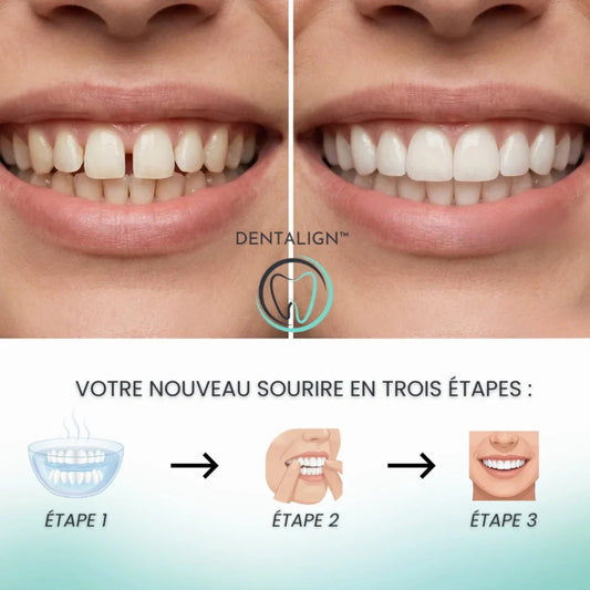Facettes Smile Amovibles - Dentalign™