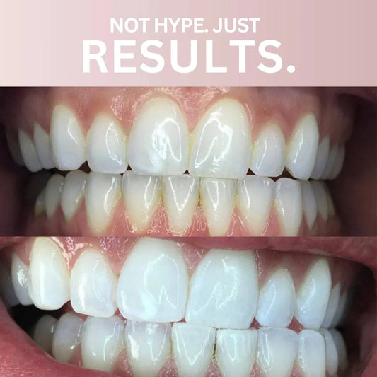 WhiteSmile™ — Bandes de Blanchiment Premium