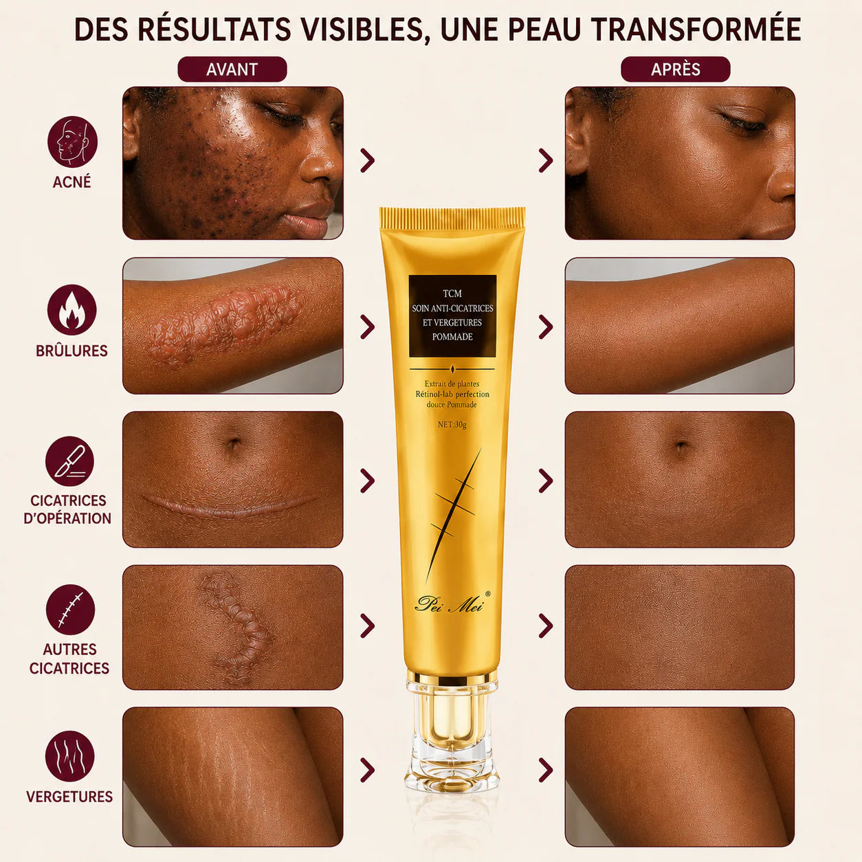 Crème Anti-Imperfection ; Réparatrice Anti-Cicatrices & VERGETURES (B-T)