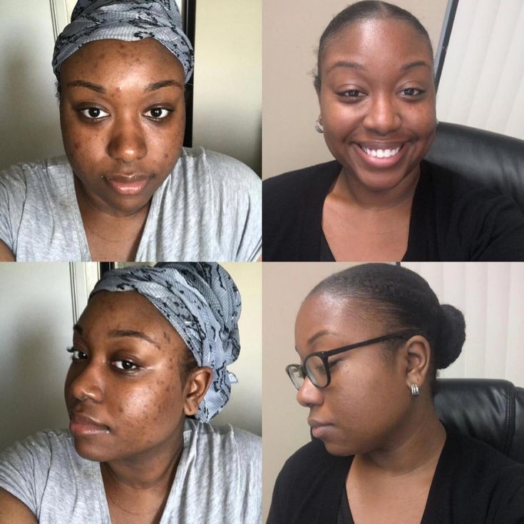 Pack de 3 Savons Kojic –Purifie, Nettoie et Illumine Visiblement la Peau