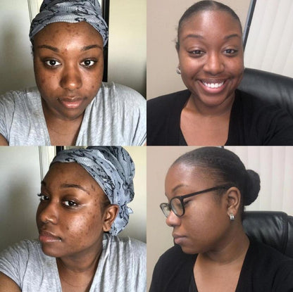 Pack de 3 Savons Kojic –Purifie, Nettoie et Illumine Visiblement la Peau