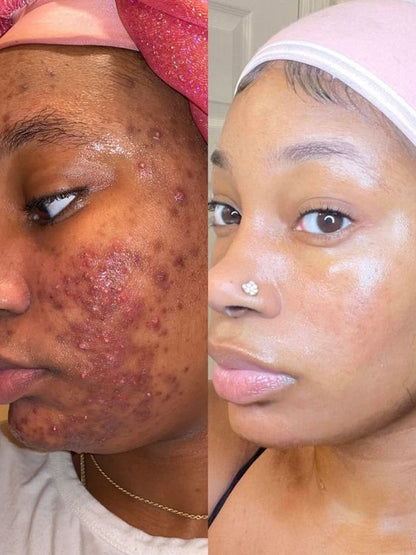 Savon Kojie San : Éclat Naturel, Peau Nette, Fraîche & Éclatante